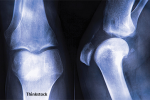 7 Things You Should Be Doing for Your Bones Now