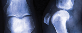 7 Things You Should Be Doing for Your Bones Now